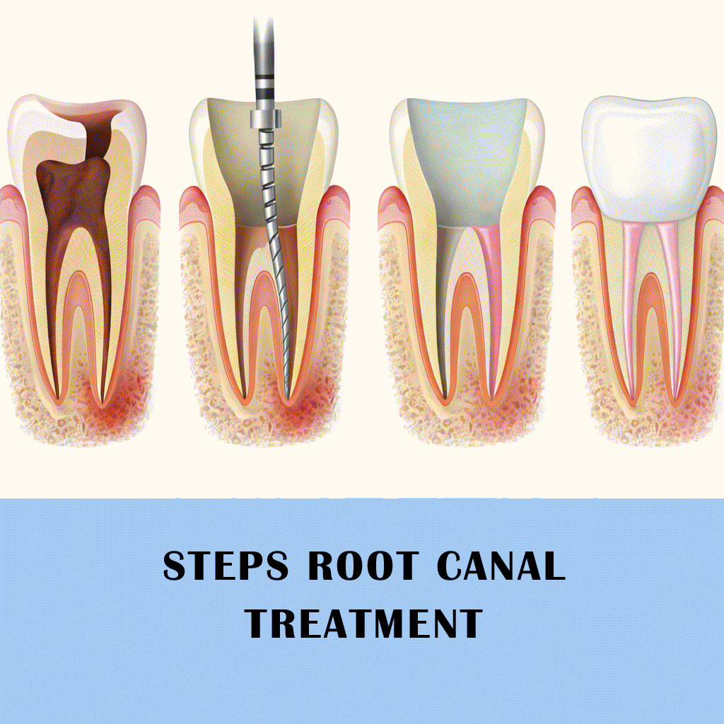 Root Canal Treatment Services